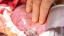 Open microwave ablation of renal transplant tumour